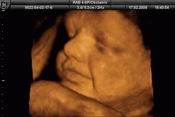 dấu hiệu thai nhi bị dị tật