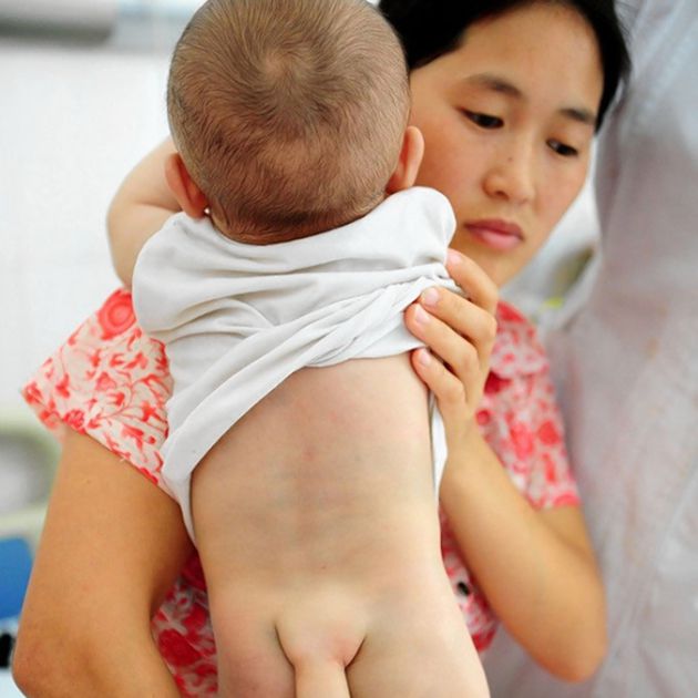 dị tật thai nhi mọc đu&ocirc;i