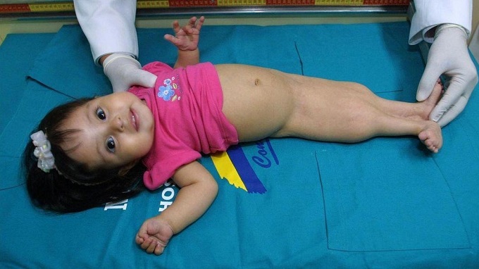 Em b&eacute; mắc hội chứng n&agrave;ng ti&ecirc;n c&aacute; do hai chi dưới d&iacute;nh liền