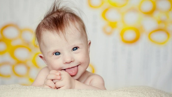 bé bị hội chứng down