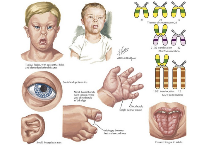 biểu hiện của em bé bị dị tật bẩm sinh hội chứng down