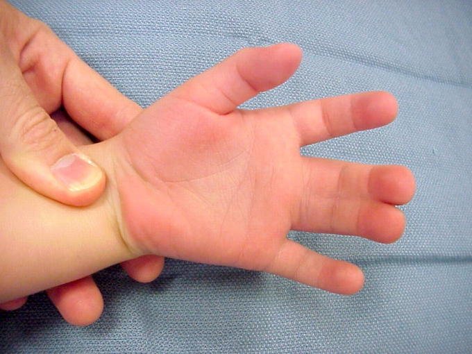 Dị tật dính ngón các chi gặp trong hội chứng Apert