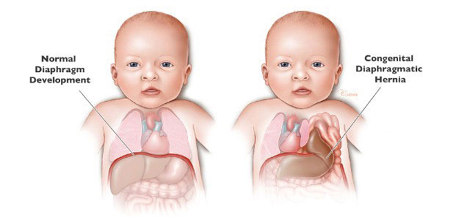 Thoát vị hoành bẩm sinh do còn ống phế - phúc mạc