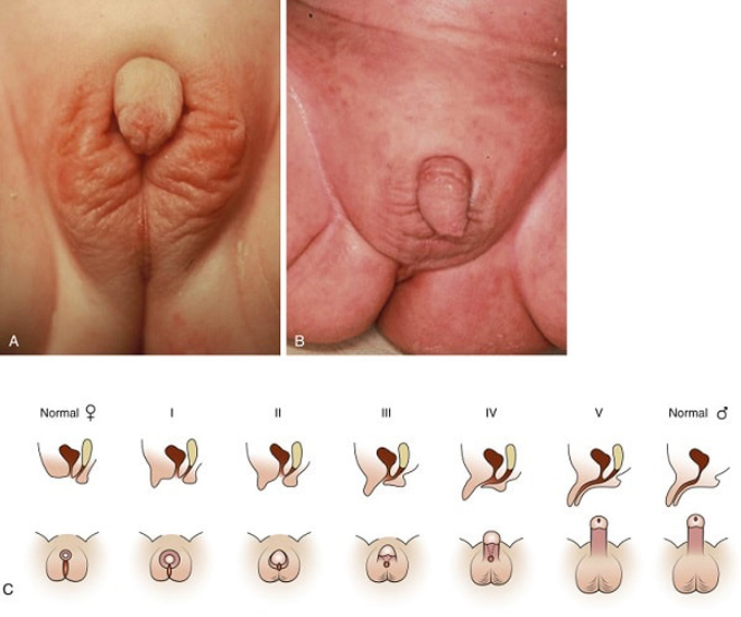 Trẻ gái sinh ra với biểu hiện nam hóa bộ phận sinh dục ngoài