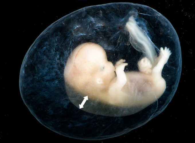 Siêu âm đo độ mờ da gáy