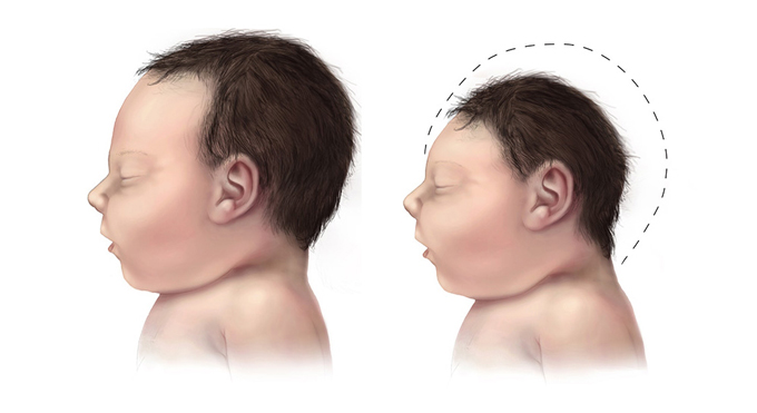 K&iacute;ch thước đầu nhỏ so với đầu b&igrave;nh thường