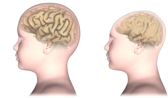 Thai nhi được chẩn đo&aacute;n mắc dị tật đầu nhỏ