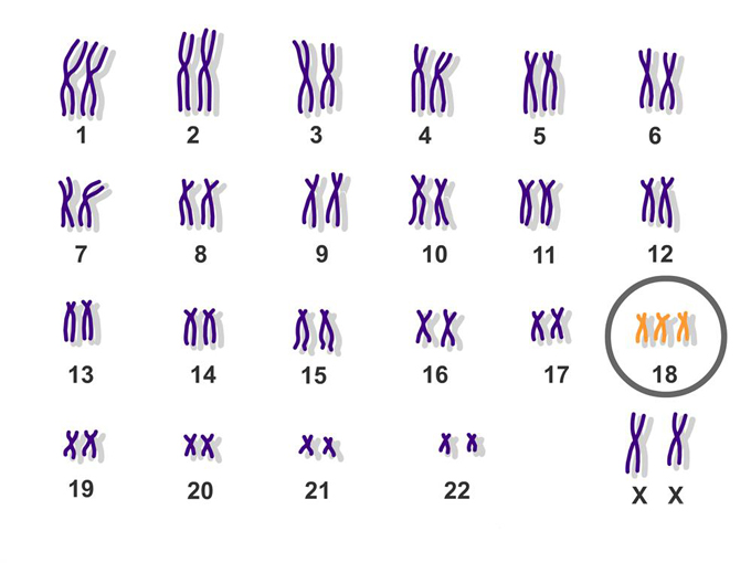 Hội chứng Edwards li&ecirc;n quan đến những bất thường ở nhiễm sắc thể số 18.