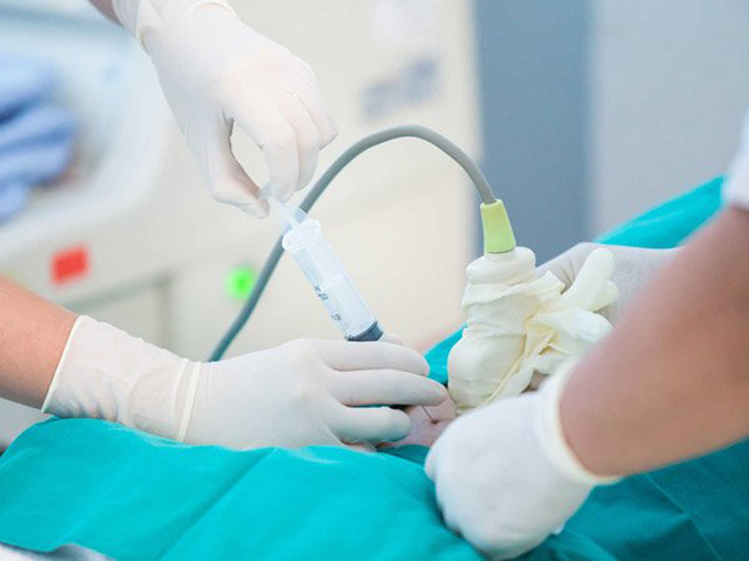 Lấy mẫu lông nhung màng đệm CVS