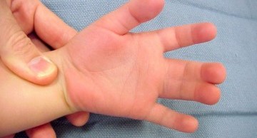  những dị tật bẩm sinh hiếm gặp