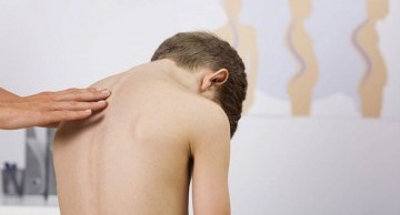 Dị tật bẩm sinh về cột sống