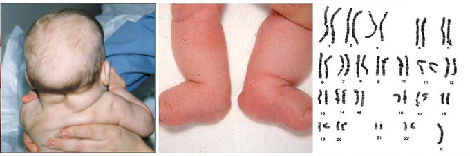 Dị tật thai nhi hội chứng Turner