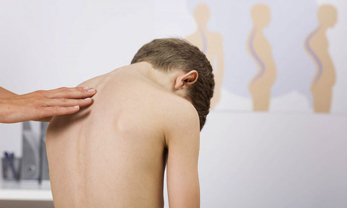 phương ph&aacute;p điều trị tật vẹo cột sống&nbsp;