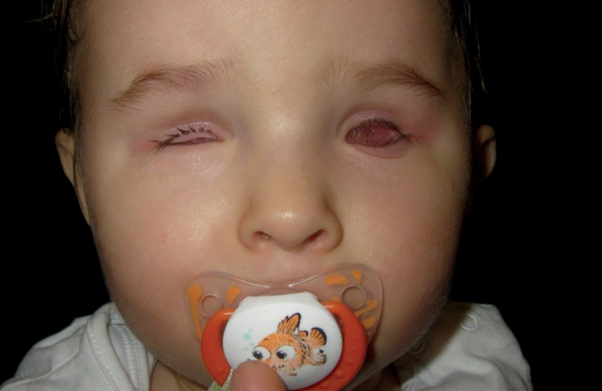 B&eacute; kh&ocirc;ng c&oacute; cả hai b&ecirc;n mắt khi mắc dị tật Anophthalmia.