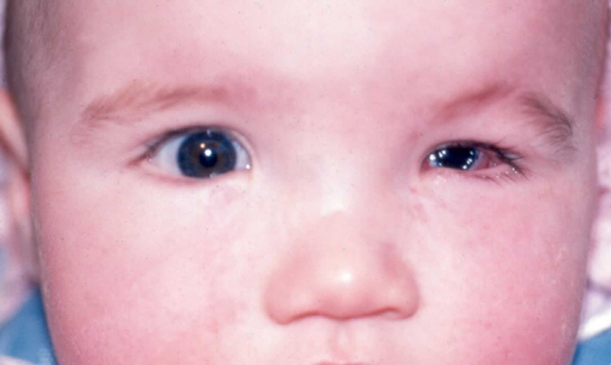 B&eacute; c&oacute; một b&ecirc;n nh&atilde;n cầu nhỏ bất thường.