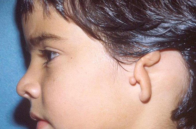 B&eacute; bị dị tật v&agrave;nh tai 