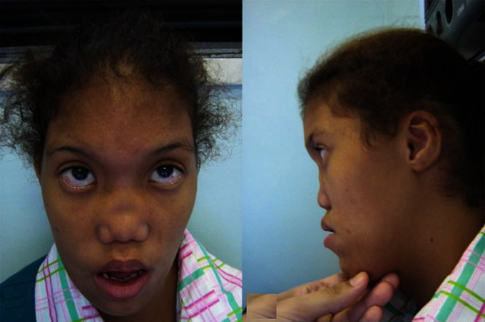 Bệnh nh&acirc;n mắc nhiều dị tật tr&ecirc;n khu&ocirc;n mặt