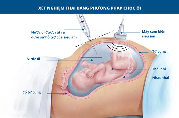 Mô tả quá trình chọc ối sàng lọc trước sinh