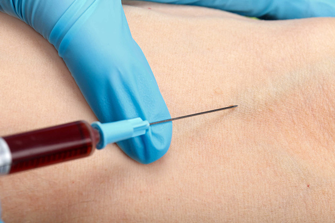 lấy m&aacute;u x&eacute;t nghiệm triple test