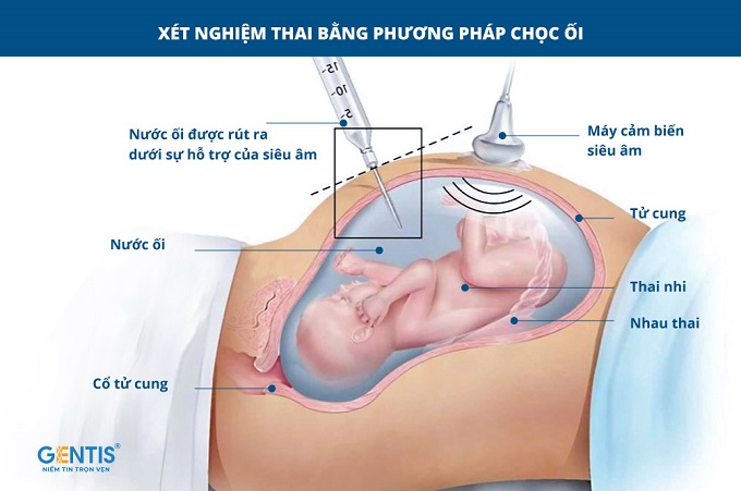 Chọc ối c&oacute; nguy cơ dẫn đến sảy thai