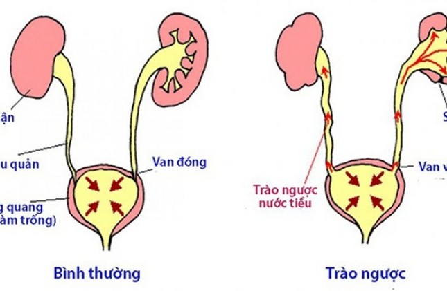 Dị tật bẩm sinh hệ tiết niệu