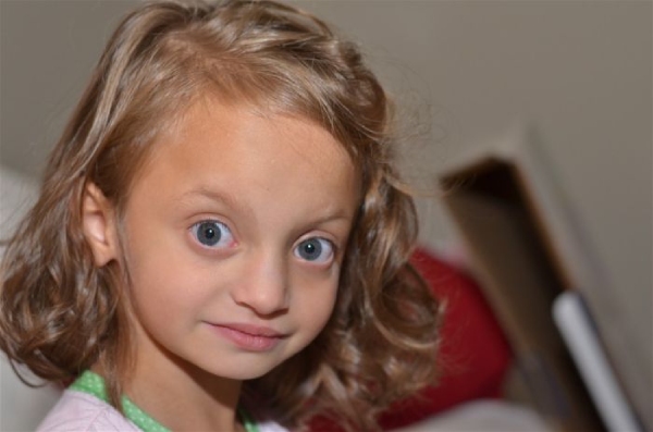 Hình ảnh trẻ mắc hội chứng Wolf- Hirschhorn